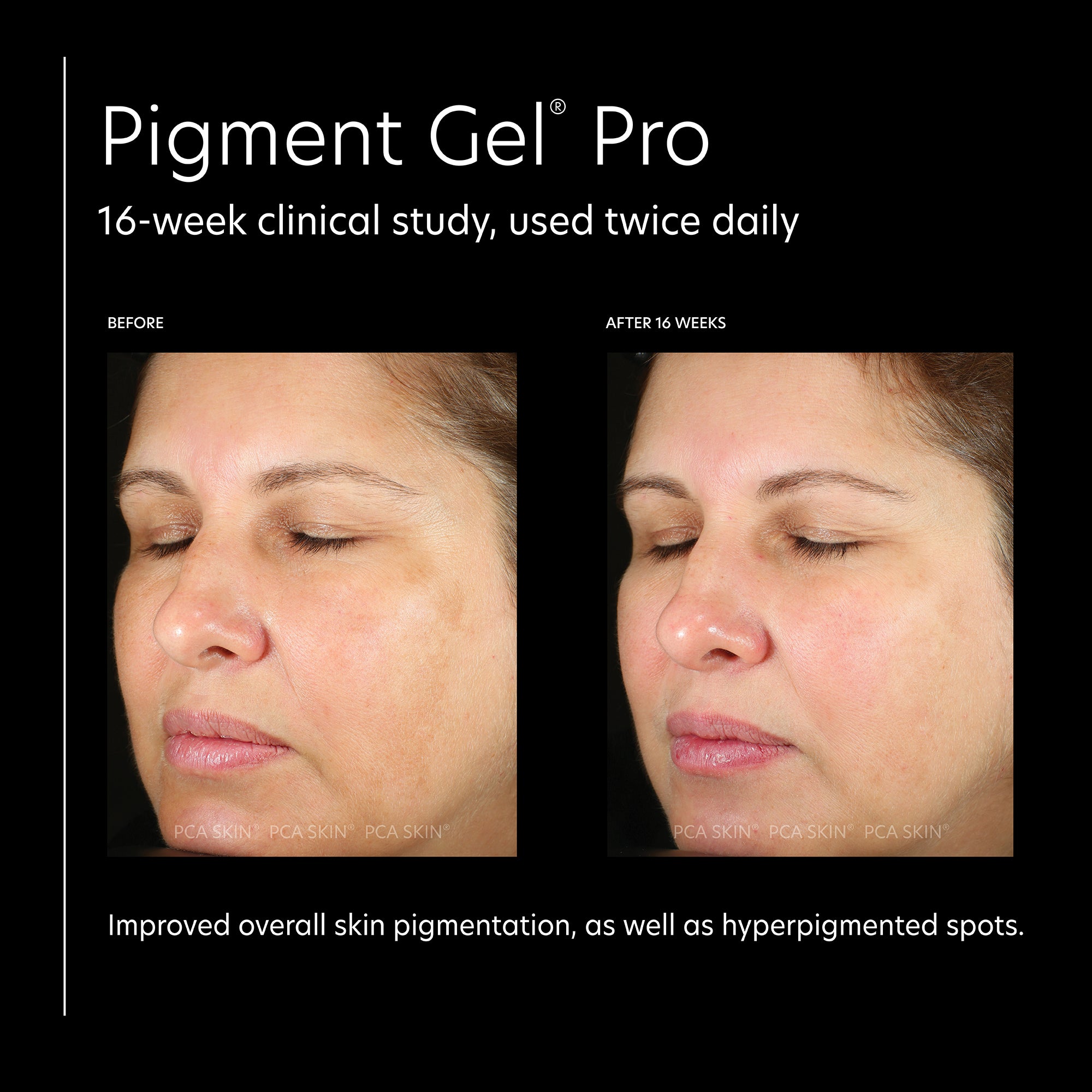 PCA Skin Pigment Gel Pro