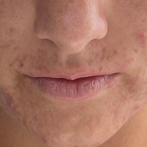 Murad Deep Relief Blemish Treatment