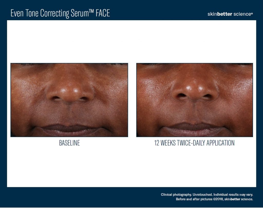 Skinbetter Science Even Tone Correcting Serum