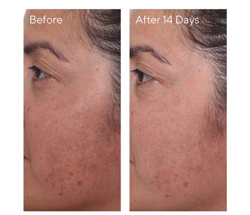 Murad Rapid Dark Spot Correcting Serum