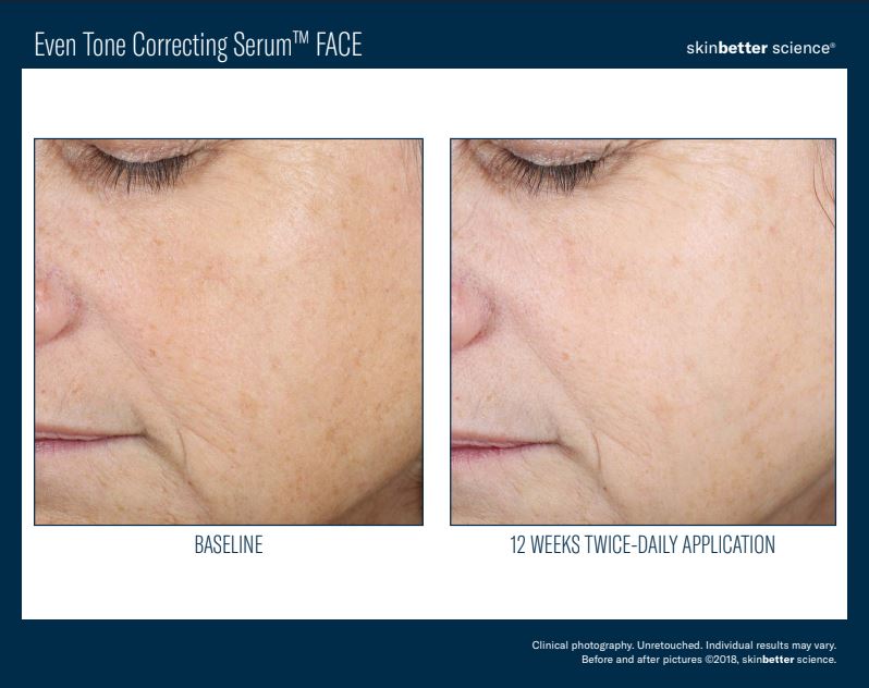 Skinbetter Science Even Tone Correcting Serum