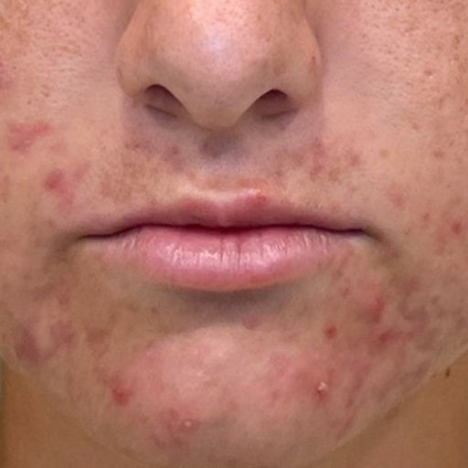 Murad Deep Relief Blemish Treatment